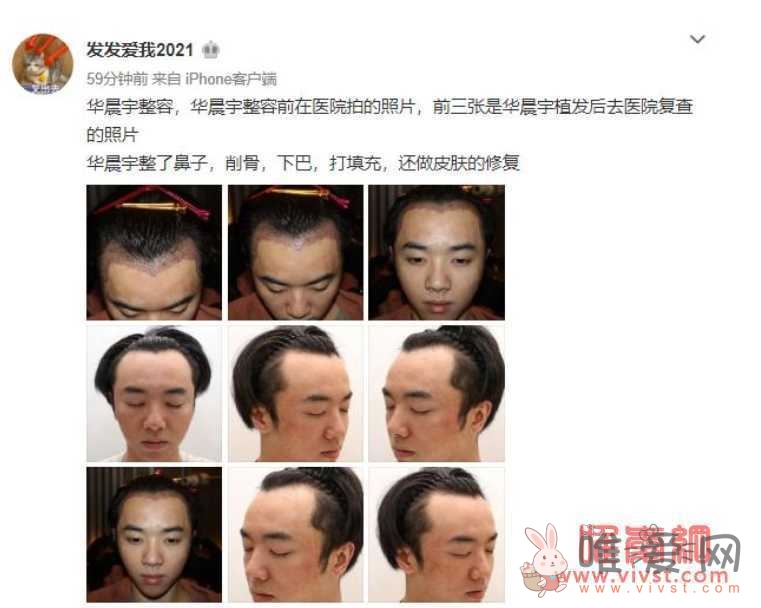 花花整容之前长什么样子照片 华晨宇植发整容照片是真的吗